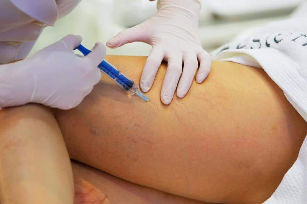 tratamiento de varices